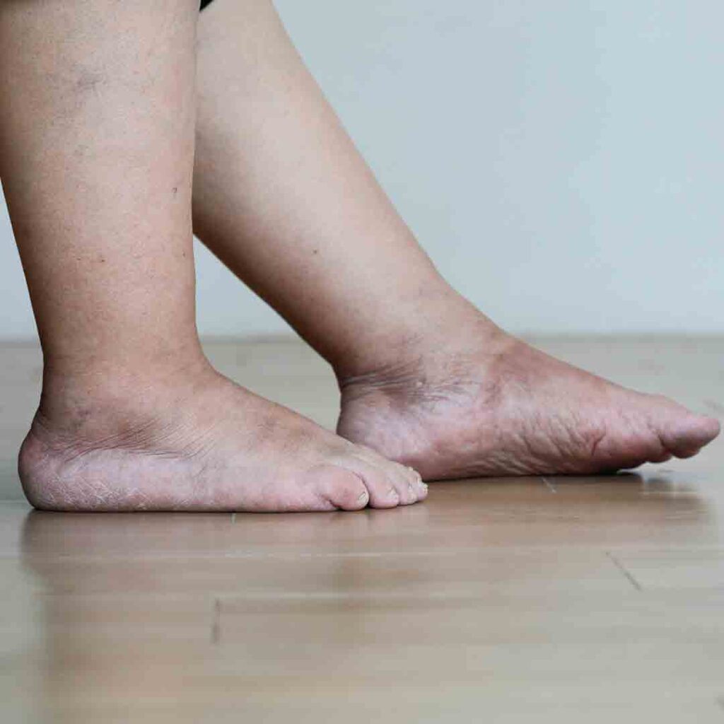 dieta-drastica-gambe-gonfie